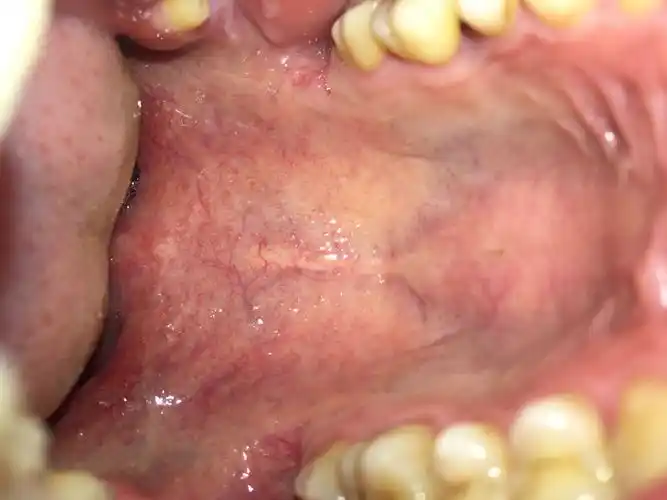 我两侧软腭一个一个黑色点是什么东西啊,还有上颚的小颗粒