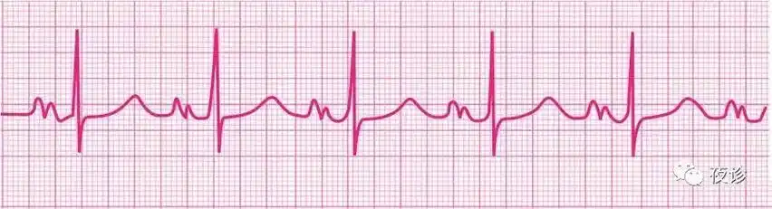 异常p波的心电图特点
