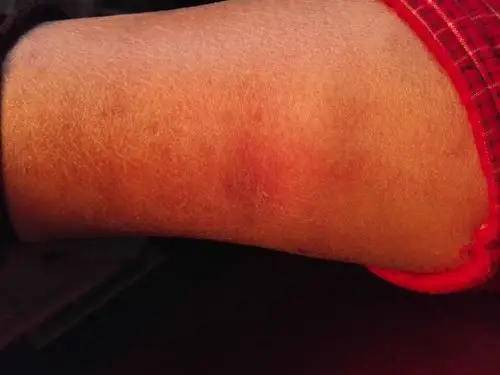 40岁的妈妈右小腿下面靠近脚踝那每次发炎都很痛,而且有时候走起路来