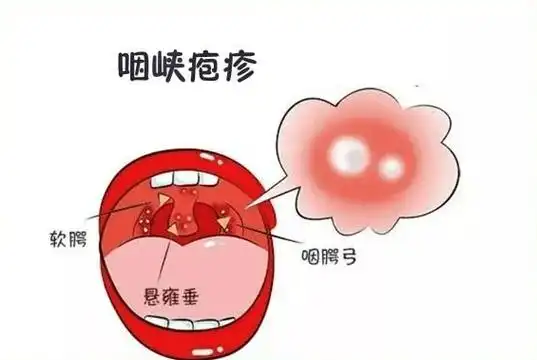 疱疹性咽峡炎是由肠道病毒感染引起的儿童急性上呼吸道感染性疾病,经