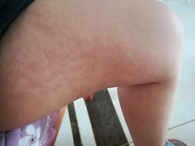 看这大腿上的生长纹每次在纹管家修复之后都有所改善,_圈子-新氧美容