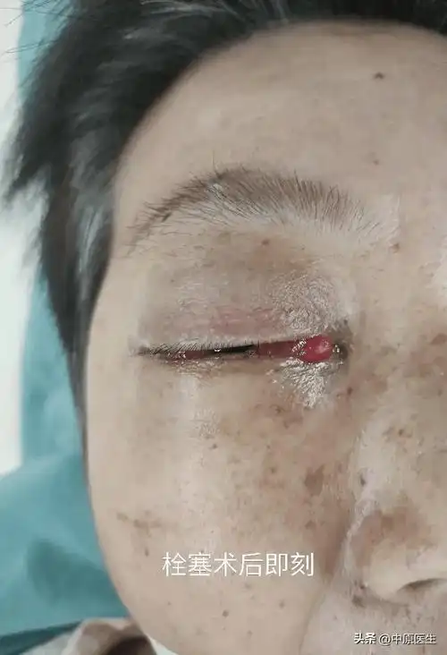 62岁女子眼球突出,睁不开眼,医生仅用两个线圈和几滴胶水治愈