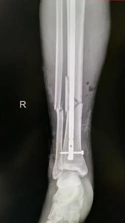 胫,腓骨骨折 - 好大夫在线