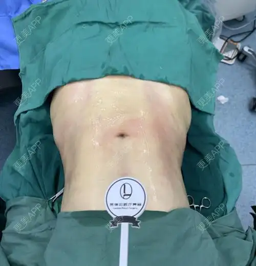 更美用户t0zppi0rhw的腰腹吸脂日记