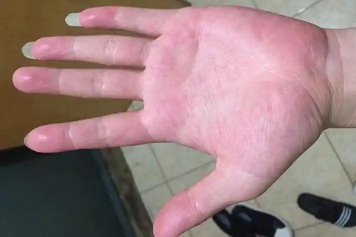 症状血热中医指血热证,与外感热邪,情志过极,过量食用辛辣燥热之品等