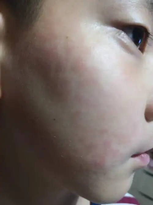 红块,怀疑是螨虫(因为这几天把沙发上的靠枕拿到床上了,与面部有接触)