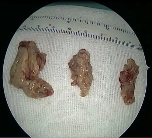 手术中上颌窦肿瘤 2.jpg