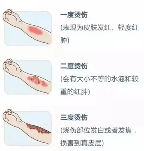 必学的急救知识6971宝宝烫伤紧急处理附烫伤程度对照图