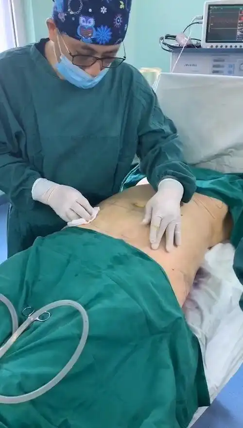 陈海良腰腹吸脂