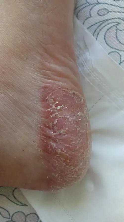 嗯 从图片看,是很典型的掌跖脓疱病,这个病是皮肤顽疾,特点就是难治愈