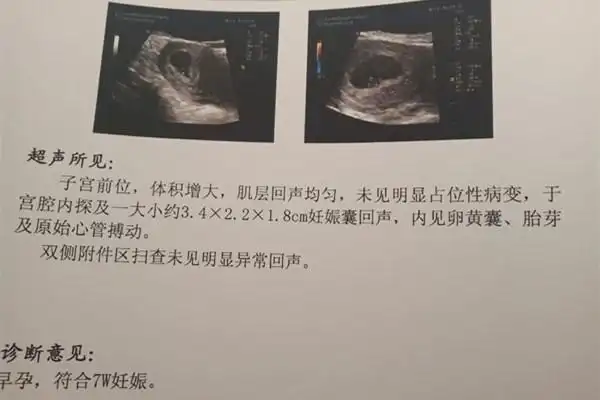 其实看孕囊很准 四十天孕囊圆形百分百女孩