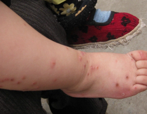 梅毒的早期症状人体有什么症状_有来医生