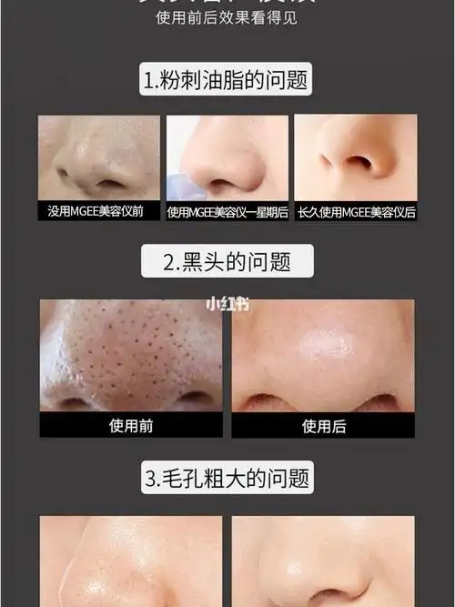 做完小气泡的效果对比图[跳跳][跳跳][跳跳]