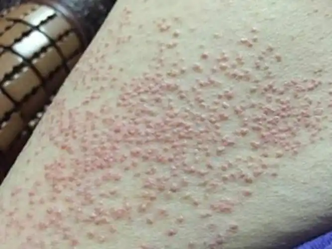 疥疮结节图片 (7)