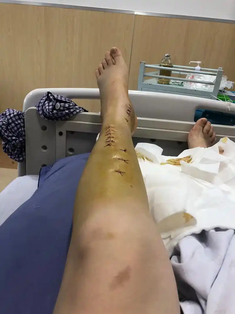 住院的日子.术后恢复第六天,坚强的背后是遍体鳞伤,扛住扛不住 - 抖音