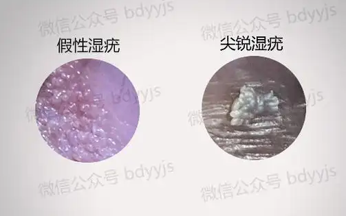 还有就是女性假性湿疣与尖锐湿疣的典型特征有明显区别,也能帮助我们