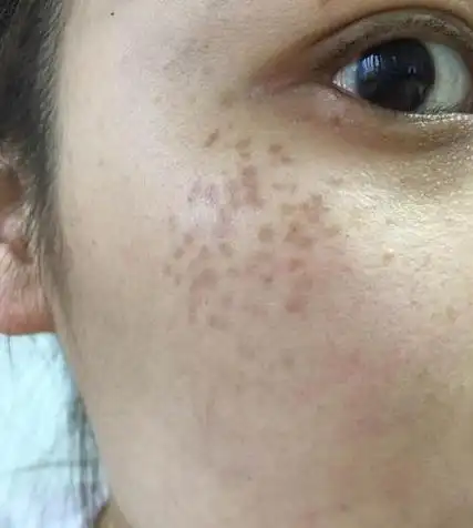 脸上长斑怎样祛除斑点(女人不想脸上长斑)(4)