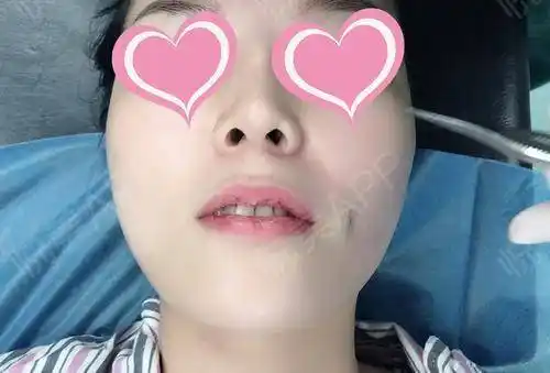 m唇手术术后7天_人造酒窝手术术后7天_唇型美化术后7天_酒窝术后7天