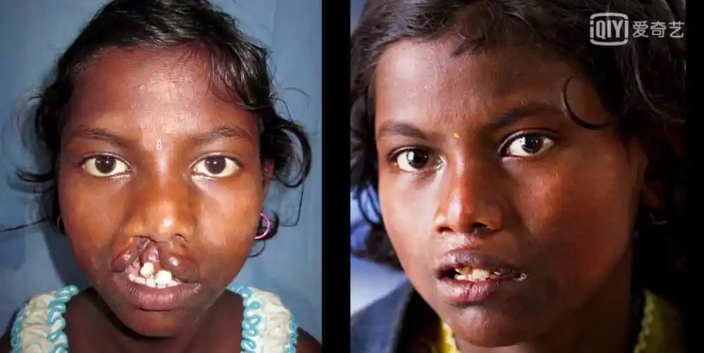 好在多数唇腭裂是可以通过 手术修复的.