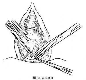 经阴道输卵管结扎术