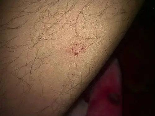 大家帮看看这伤口是什么动物咬伤的