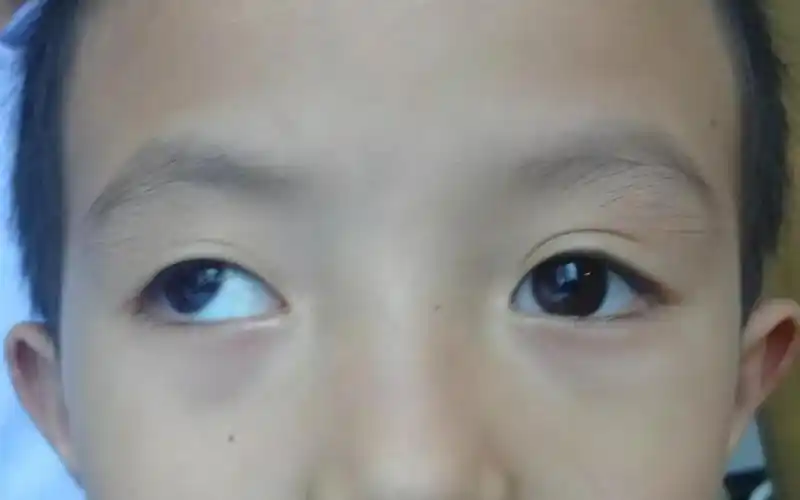 斜视矫正的神操作:5条眼肌,一步到位!