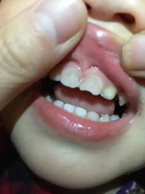 医生你好宝宝22个月今天回家我发现他的一只大门牙脱落了一