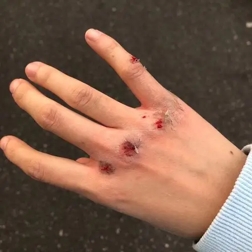 求助这种摔伤的伤口会留疤吗