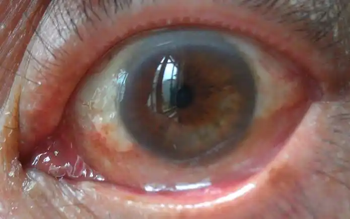 请问一下,我家老人,眼睛眼白处有点突出,请问是什么状况