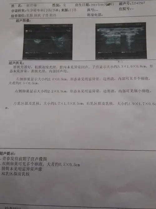 女儿5岁4个月,左乳探及乳核大小约1.7x1.5x0.5cm,右乳核约1.9x1.7x0.
