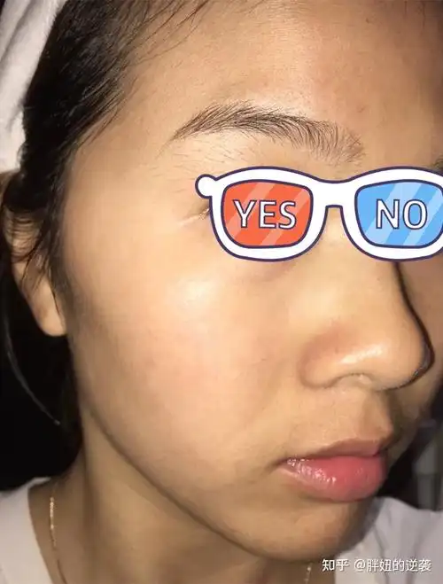 熬夜导致脸色发黄怎么办