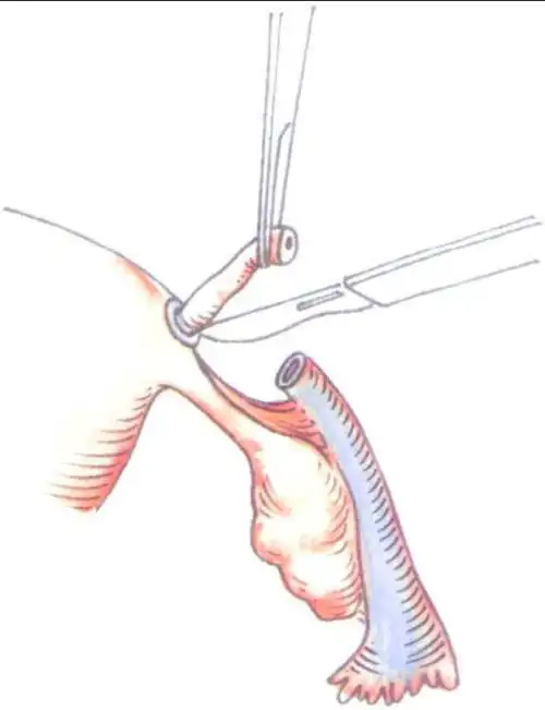 结扎后的复通手术就是做了结扎以后想要恢复原状的手术,结扎一般是