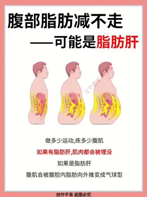 腹部脂肪减不掉小心是脂肪肝