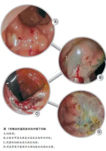 emr治疗难治性结直肠病变 可安全有效地治疗体积.