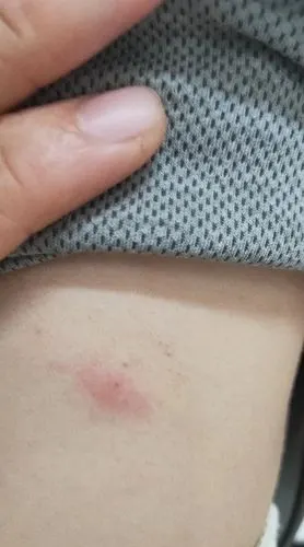 麻烦问下,这个像是什麽虫子咬的?