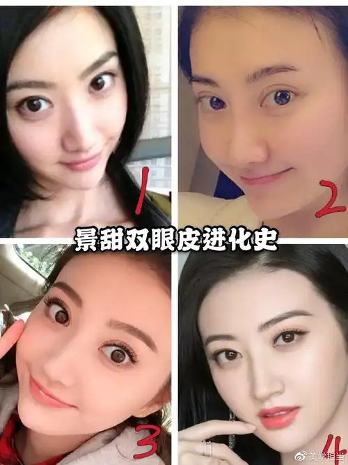 景甜耿直自曝双眼皮做失败变悲伤蛙景甜双眼皮是怎么逆袭变美的