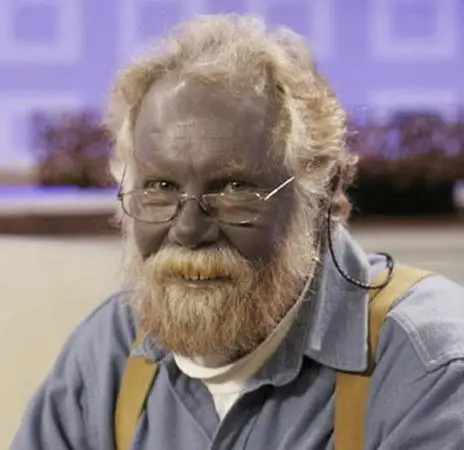 纳美人真实版 美国「蓝血人」卡拉森逝世