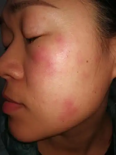 湿疹/皮炎合并感染