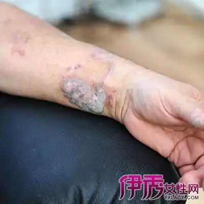 【图】血毒引起的皮肤病图片出炉 下面介绍几种中医中药奇方秘方