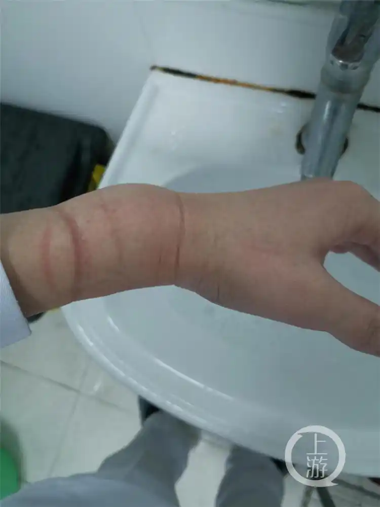 重庆援鄂医护抗疫日记24丨90后男护士身上的勒痕让人心疼