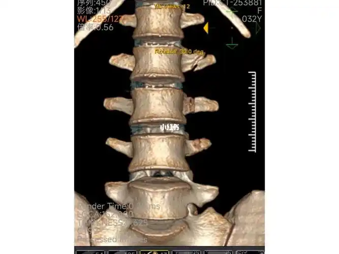横突骨折3根,都是多久上班的?