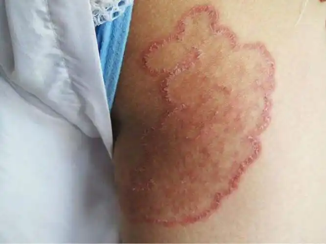 后背体股癣图片_有来医生