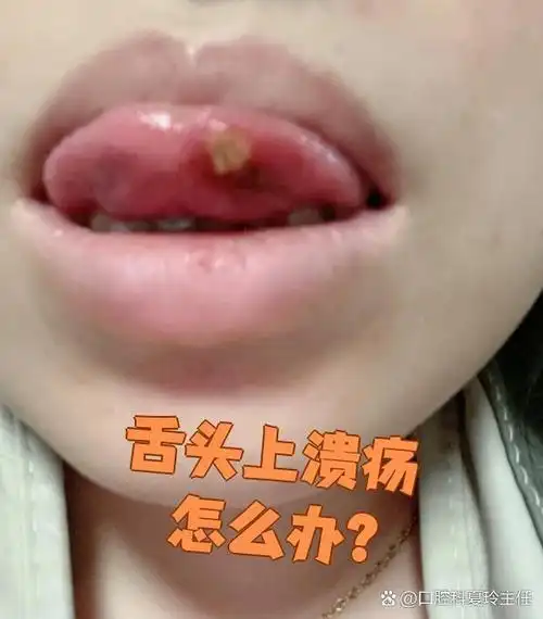 舌头上溃疡常见原因有三种,咱们一个一个说清楚