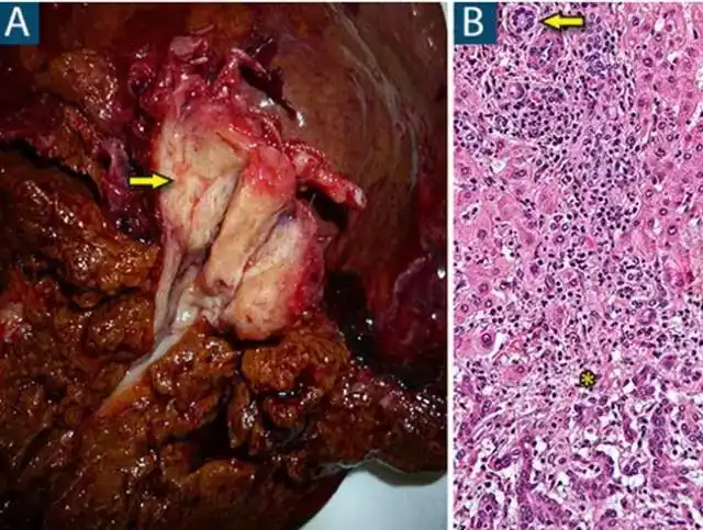 14种常见肝脏良恶性肿瘤图解