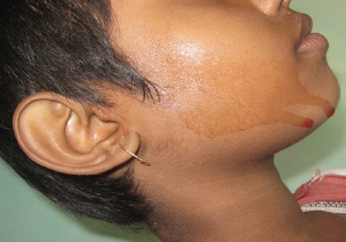 什么叫做血汗病?