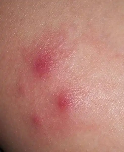 一晚上起来,大腿起了好几个红疙瘩,一压就疼,这是怎么回事?