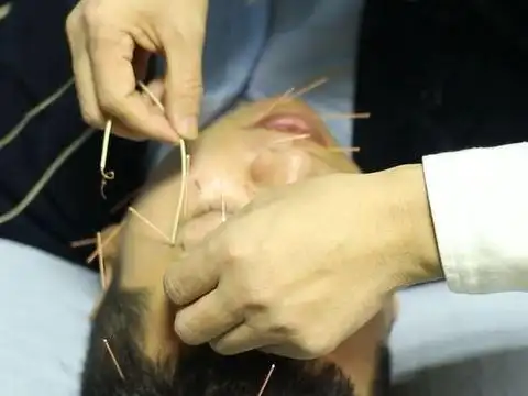 口眼歪斜,漱口漏水,得了面瘫速速去针灸