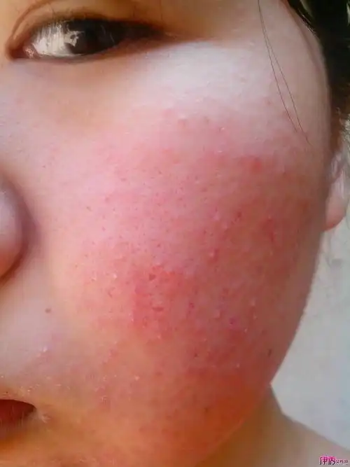 春天到了,如何预防敏感肌肤?