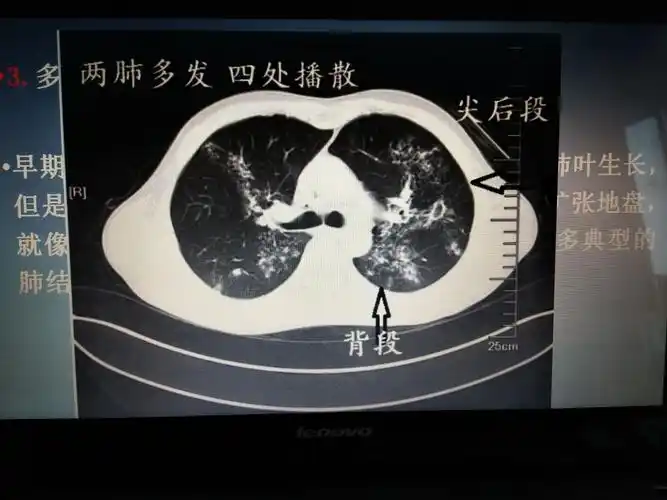 肺结核ct影像表现