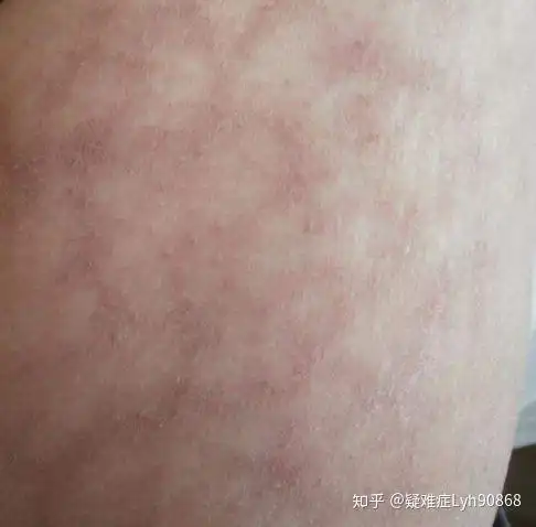 网状青斑老中医血络散斑汤治疗